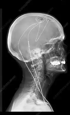 Radiograph showing the deep stimulation device used to treat Parkinson's disease