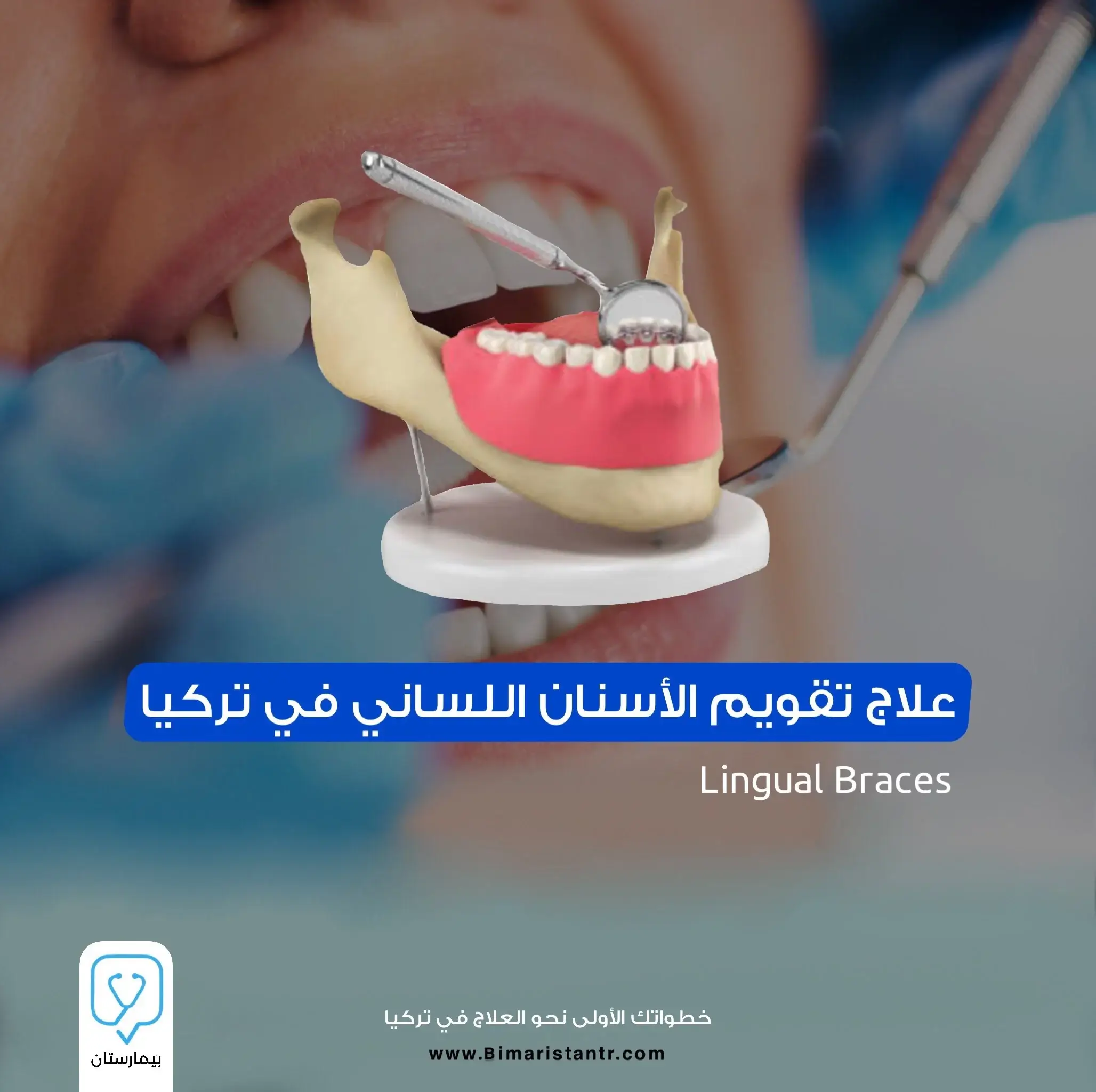 علاج تقويم الأسنان اللساني في تركيا