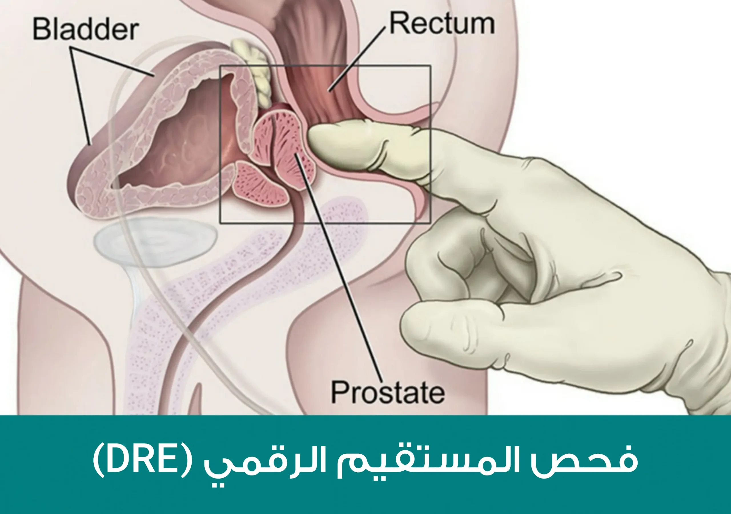 فحص المستقيم الرقمي (DRE) والمعروف بالمس الشرجي