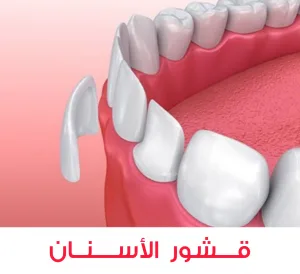 قشور الأسنان عبارة عن عدسات رقيقة تجميلية تلصق على سطح الأسنان