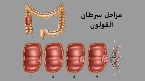 مراحل سرطان القولون