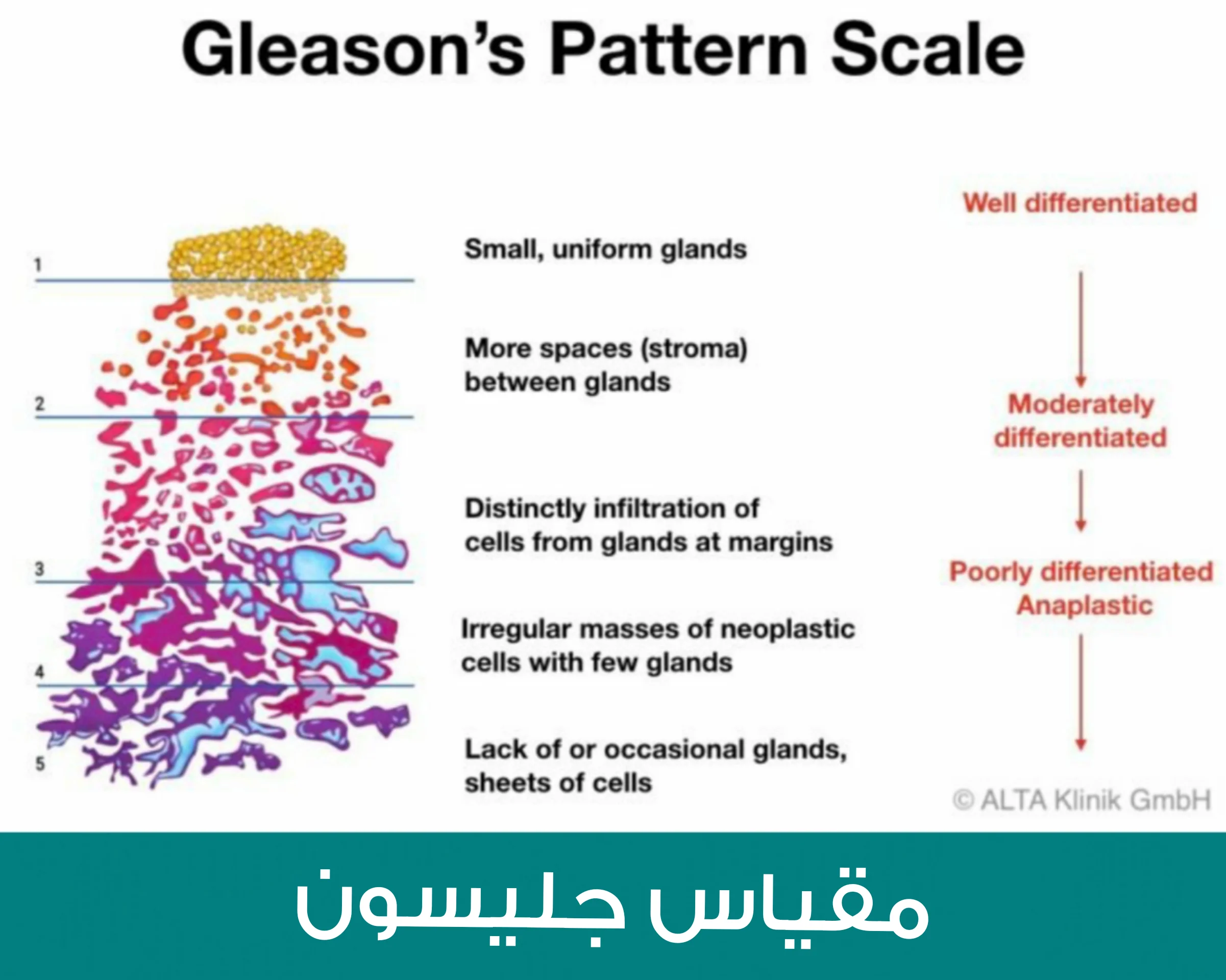 Gleason staging scale for prostate cancer