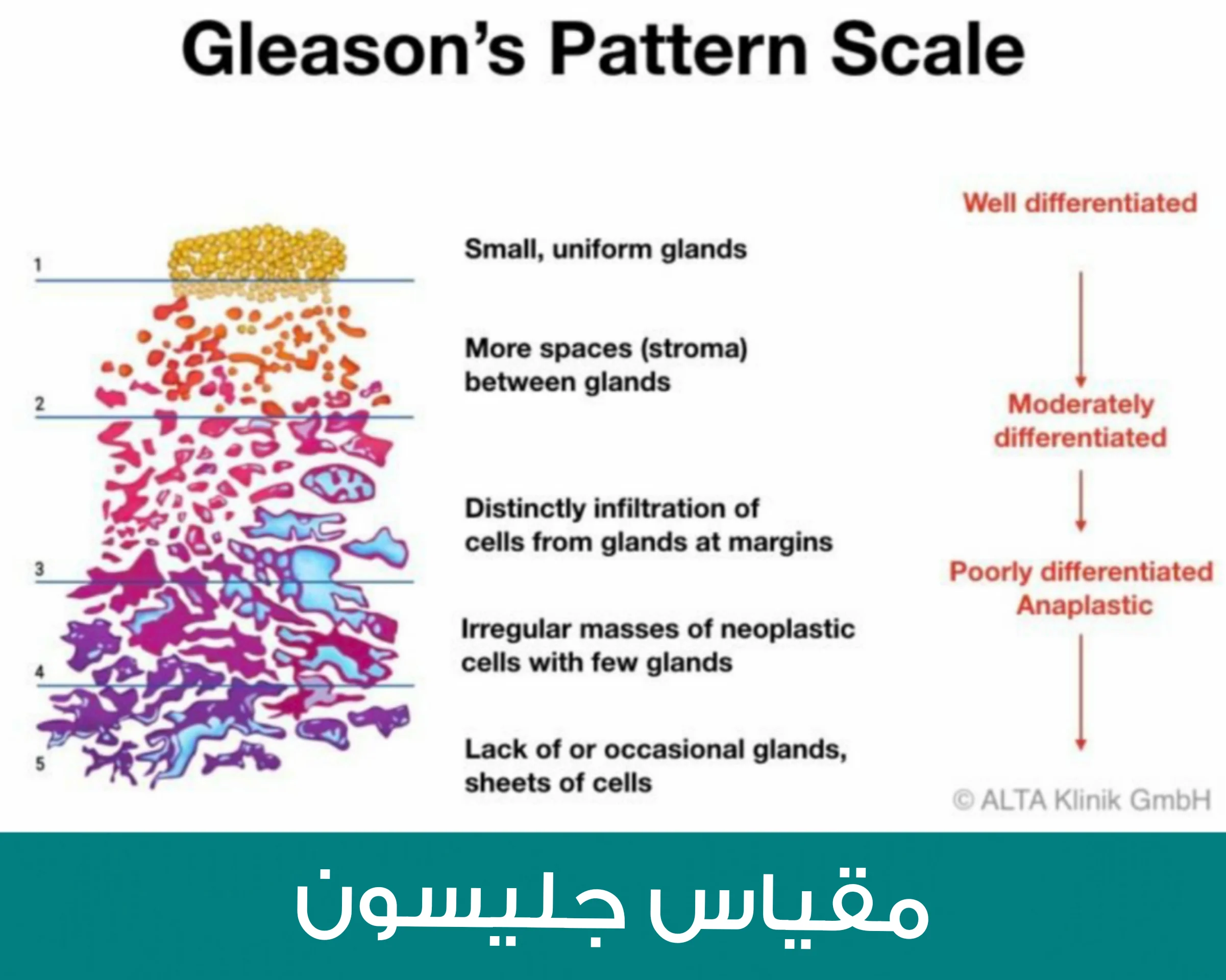 مقياس جليسون لقياس مراحل سرطان البروستات