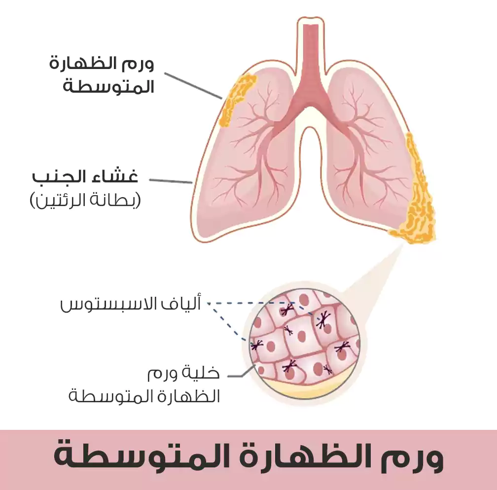 توضع ورم الظهارة المتوسطة وكيف يظهر على المستوى الخلوي