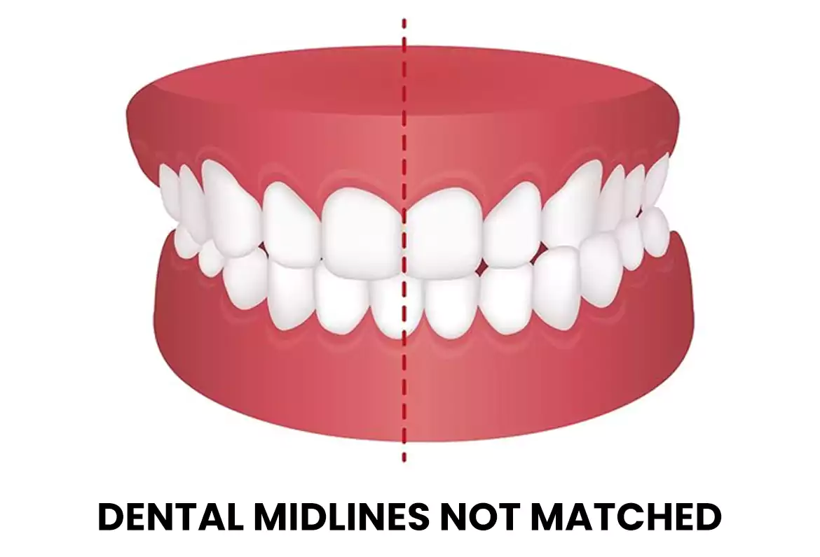 انحراف الخط المتوسط للأسنان DENTAL MIDLINES NOT MATCHED