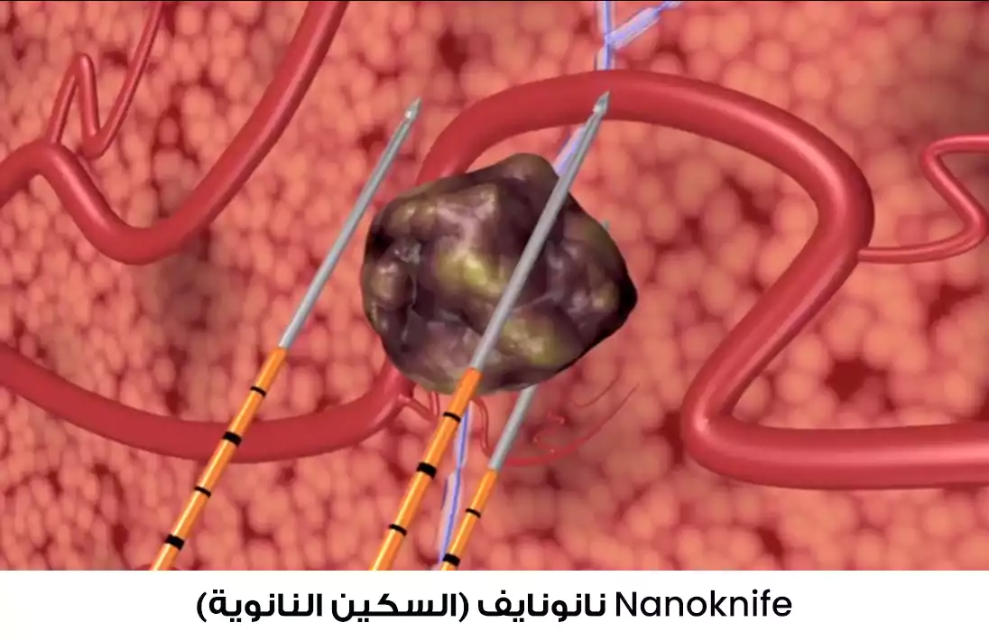 قتل الخلايا السرطانية عبر استخدام تقنية النانو نايف