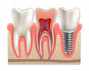 Diş implantı ameliyatı