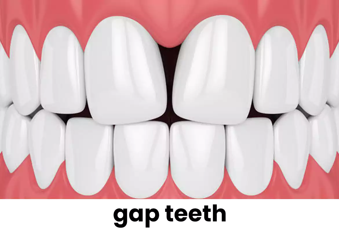 الفجوة بين الأسنان gap teeth