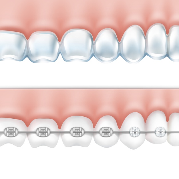 تقويم الأسنان اللساني غير واضح لأنه يكون على جهة اللسان