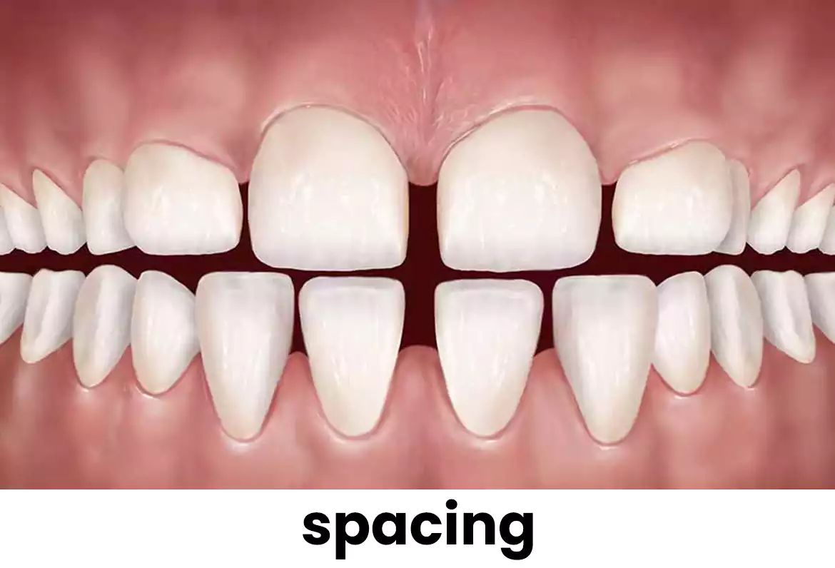 dental spaces spacing