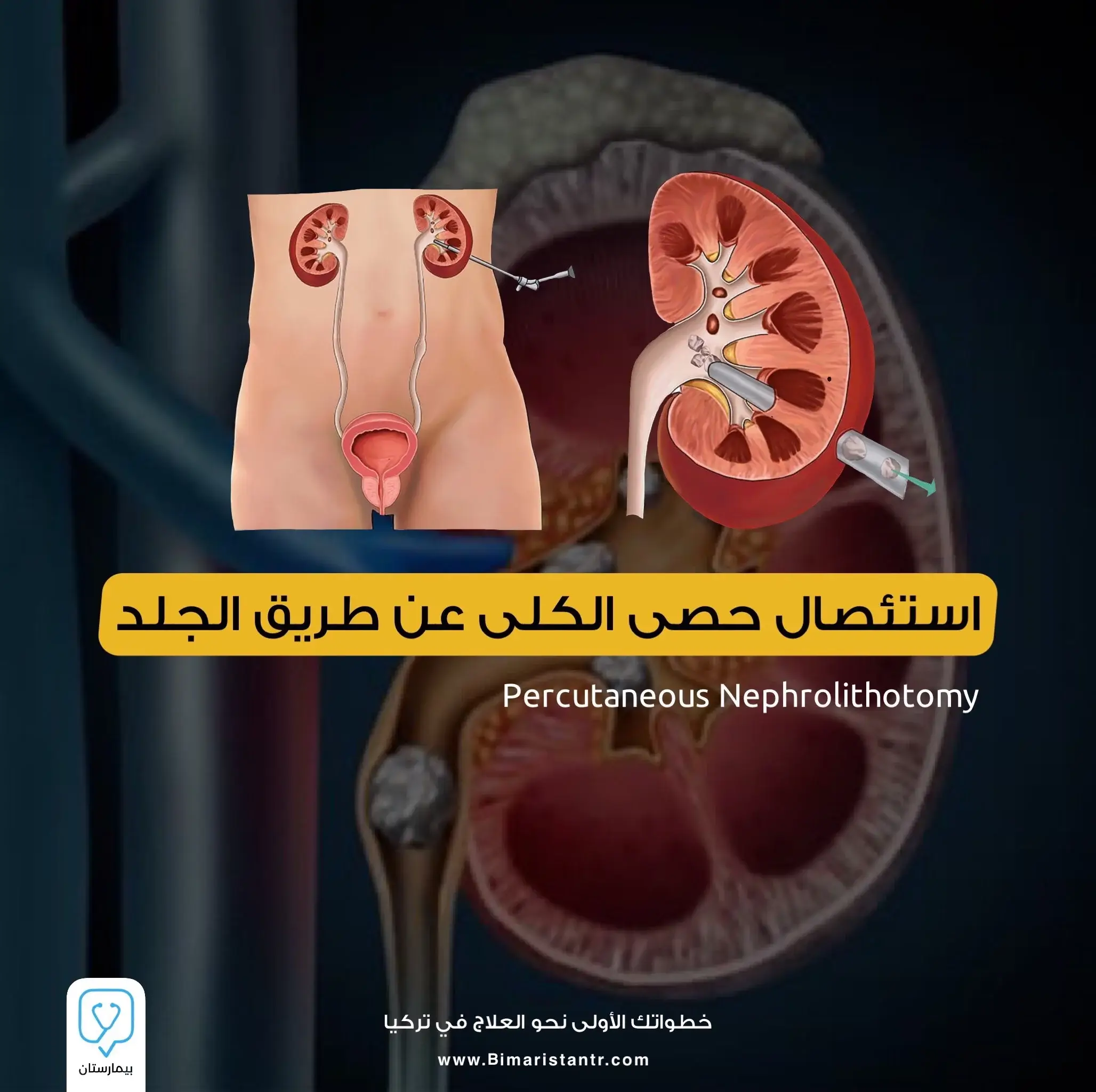 Percutaneous excision of kidney stones