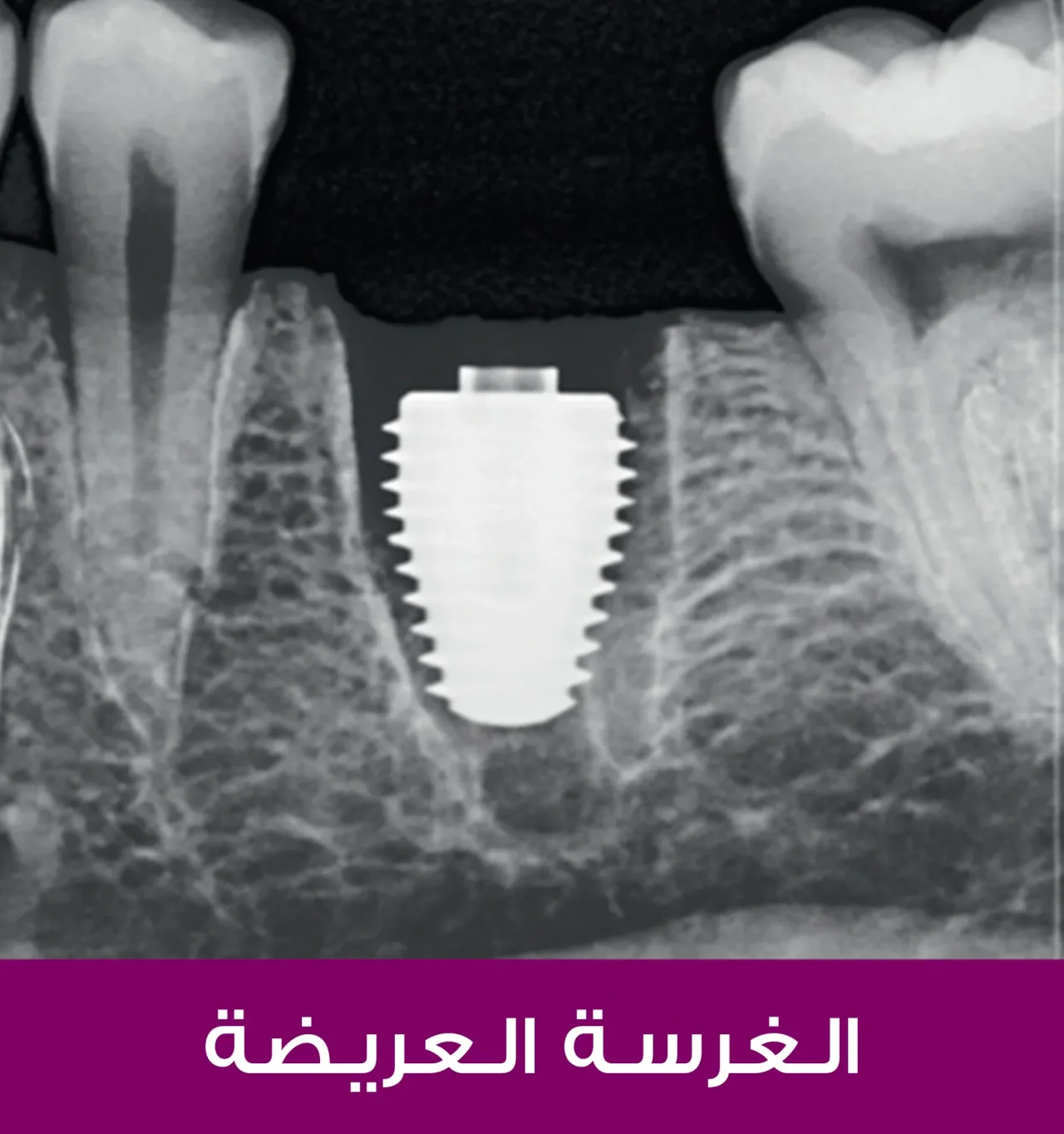 Кюретаж лунки удалённого зуба