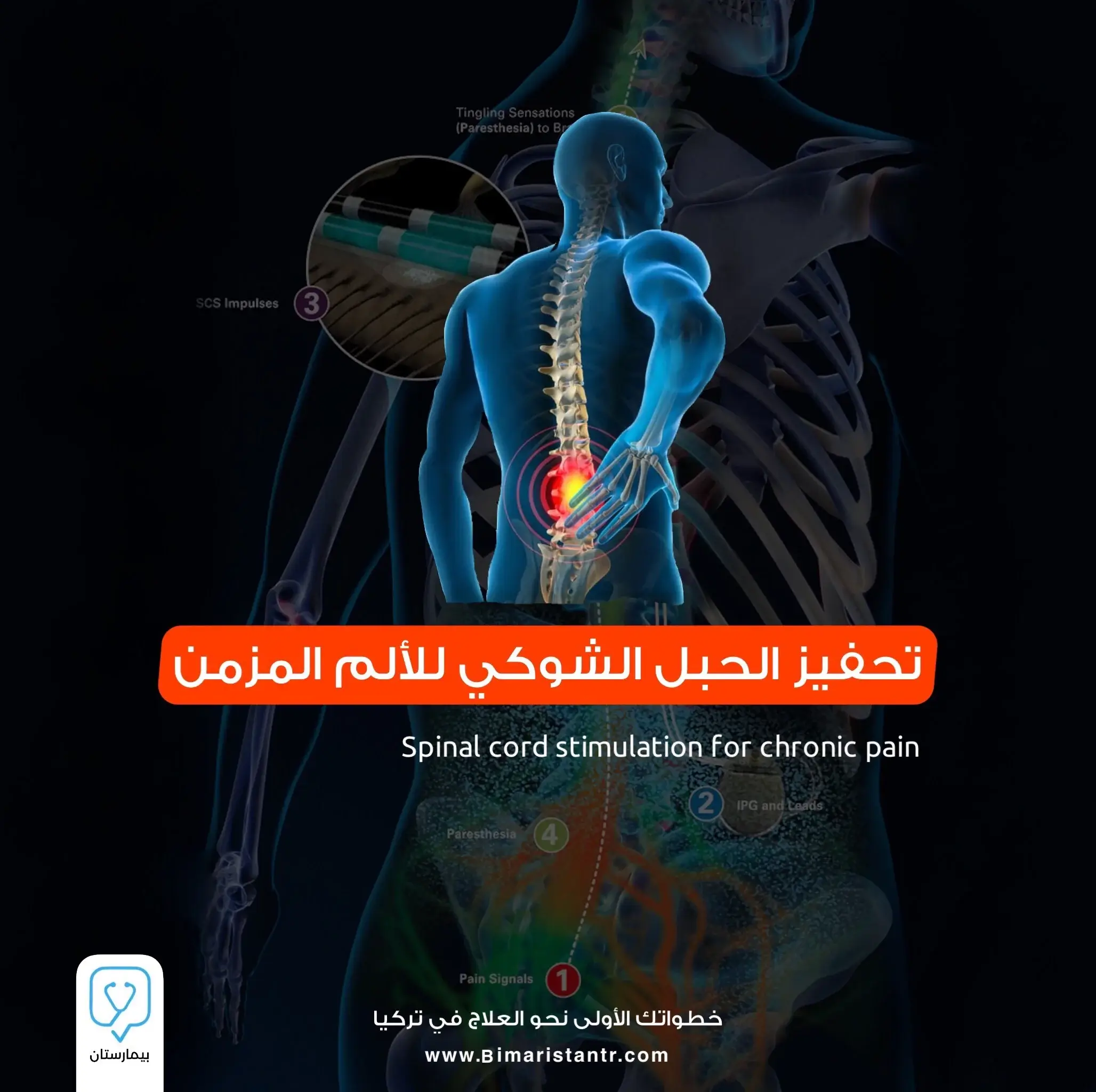 Spinal Cord Stimulation for Chronic Pain in Turkey