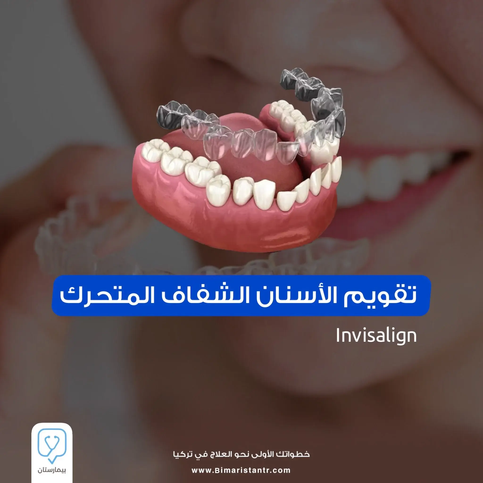 تقويم الأسنان الشفاف المتحرك