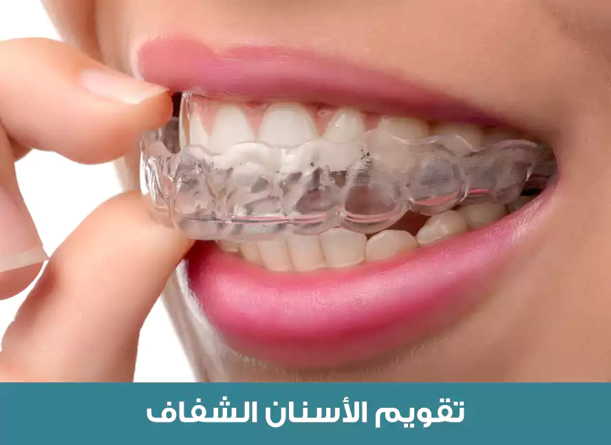 أفضل أنواع تقويم الأسنان في تركيا هو التقويم الشفاف