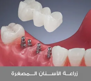 زراعة الأسنان المصغرة