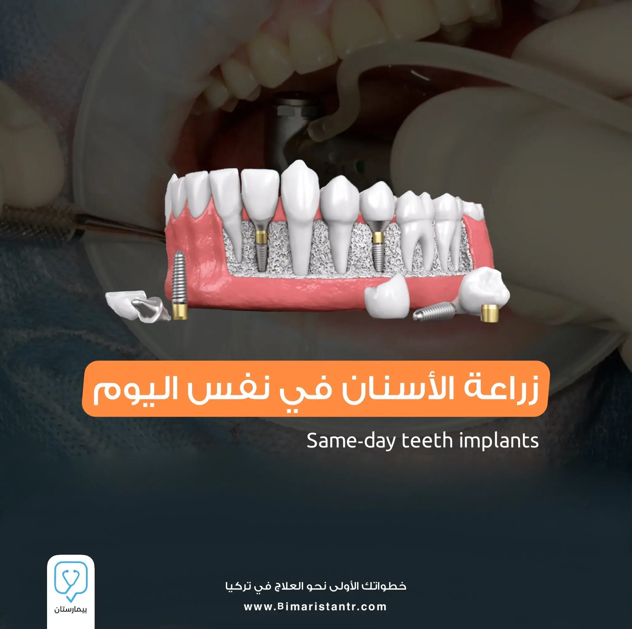 Dental implants on the same day