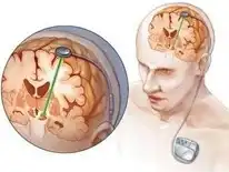 صورة مقربة لتموضع الجهاز في الدماغ