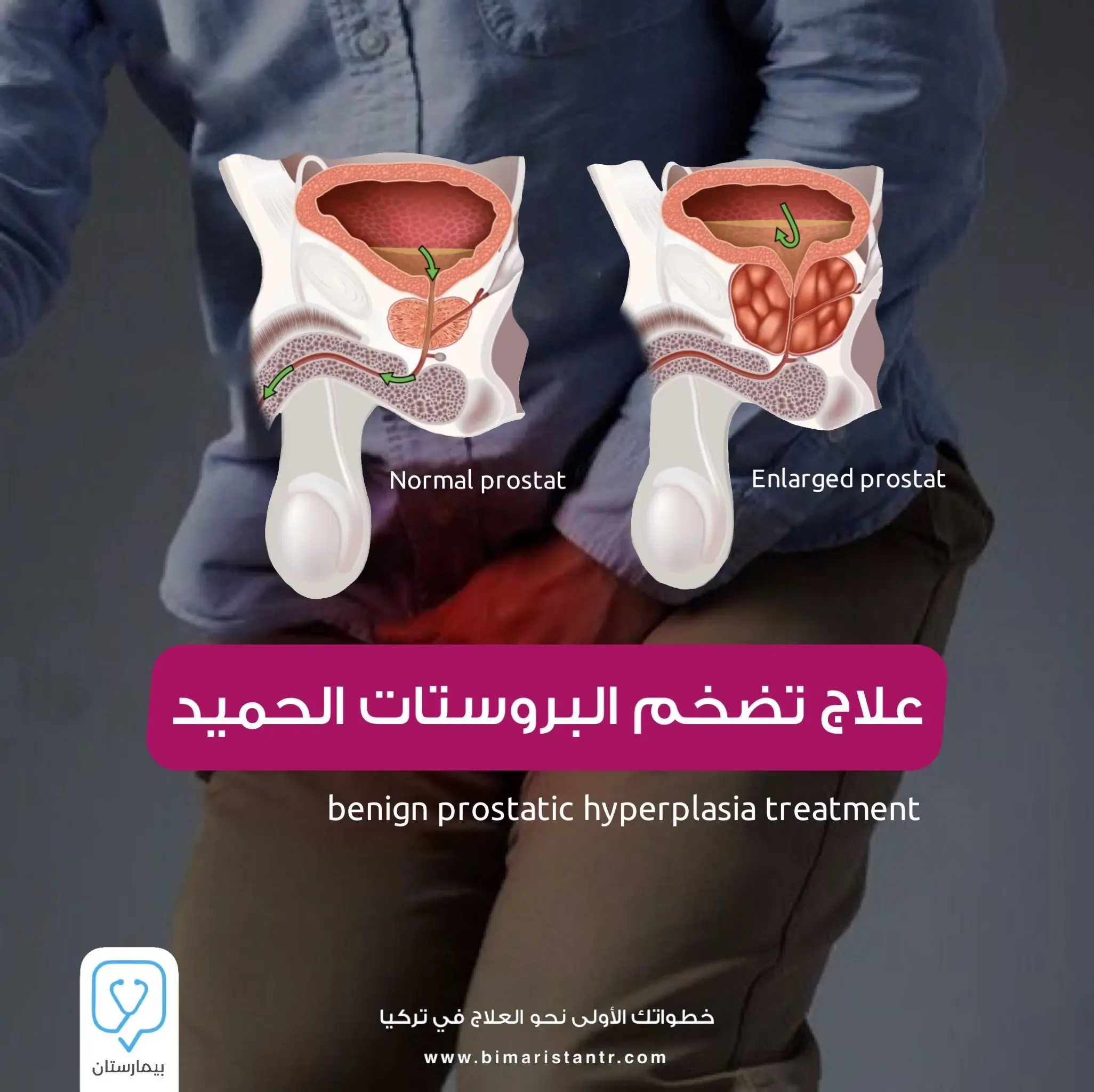 Türkiye'de iyi huylu prostat hiperplazisi tedavisi