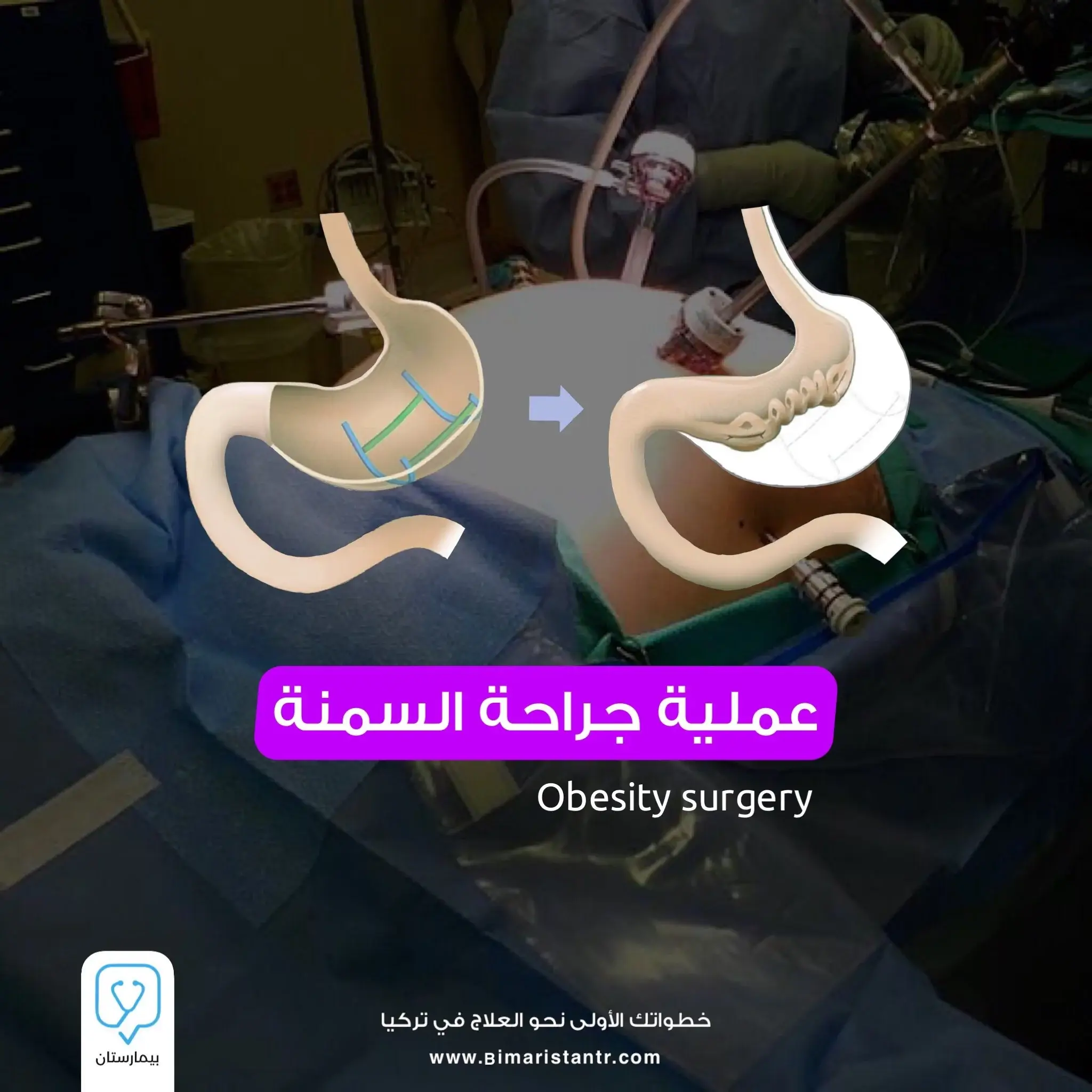 Obesity surgery