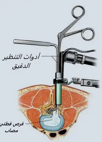 أدوات التنظير الدقيق المستخدمة في جراحة العمود الفقري طفيفة التوغل في تركيا