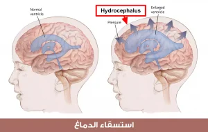 استسقاء الدماغ