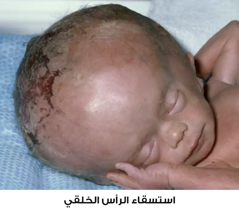 Photo of a newborn with congenital hydrocephalus