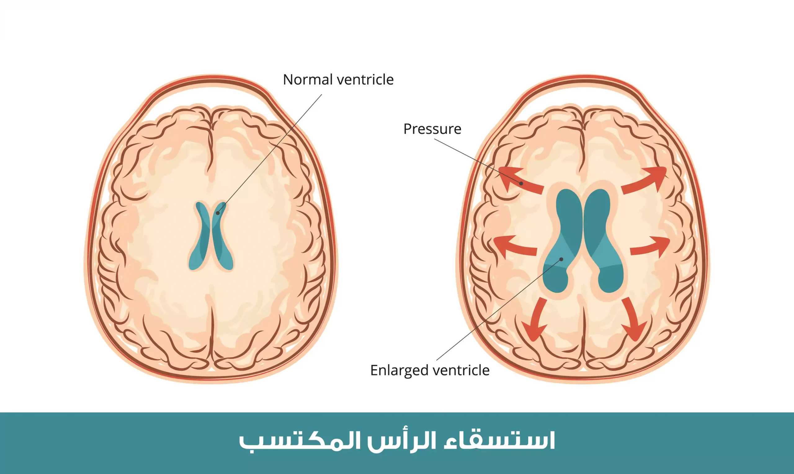 استسقاء الرأس المكتسب والذي يحصل بعد الولادة نتيجة أسباب مختلفة تمنع تصريف السائل الدماغي الشوكي