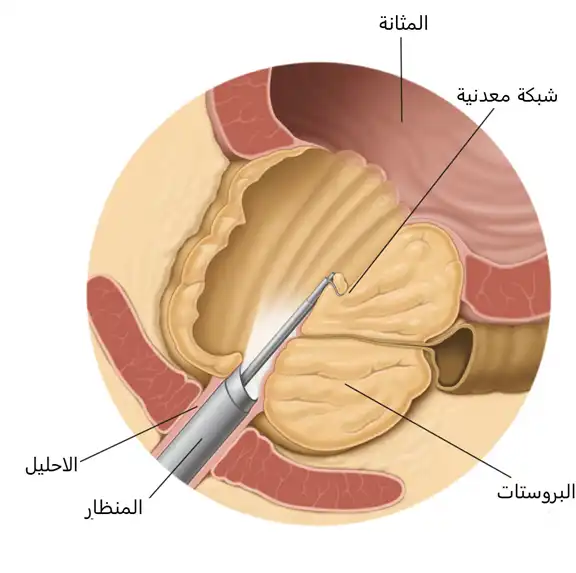 استئصال سرطان المثانة عبر الإحليل (TURBT)