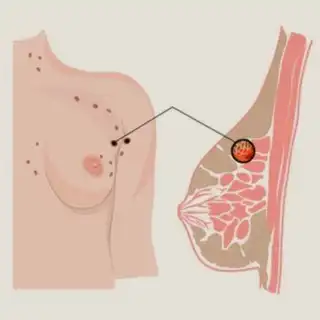 نمو الخلايا المفرط على حساب نسيج الثدي حيثُ تزيد هذه الحالة من خطور الإصابة بسرطان الثدي