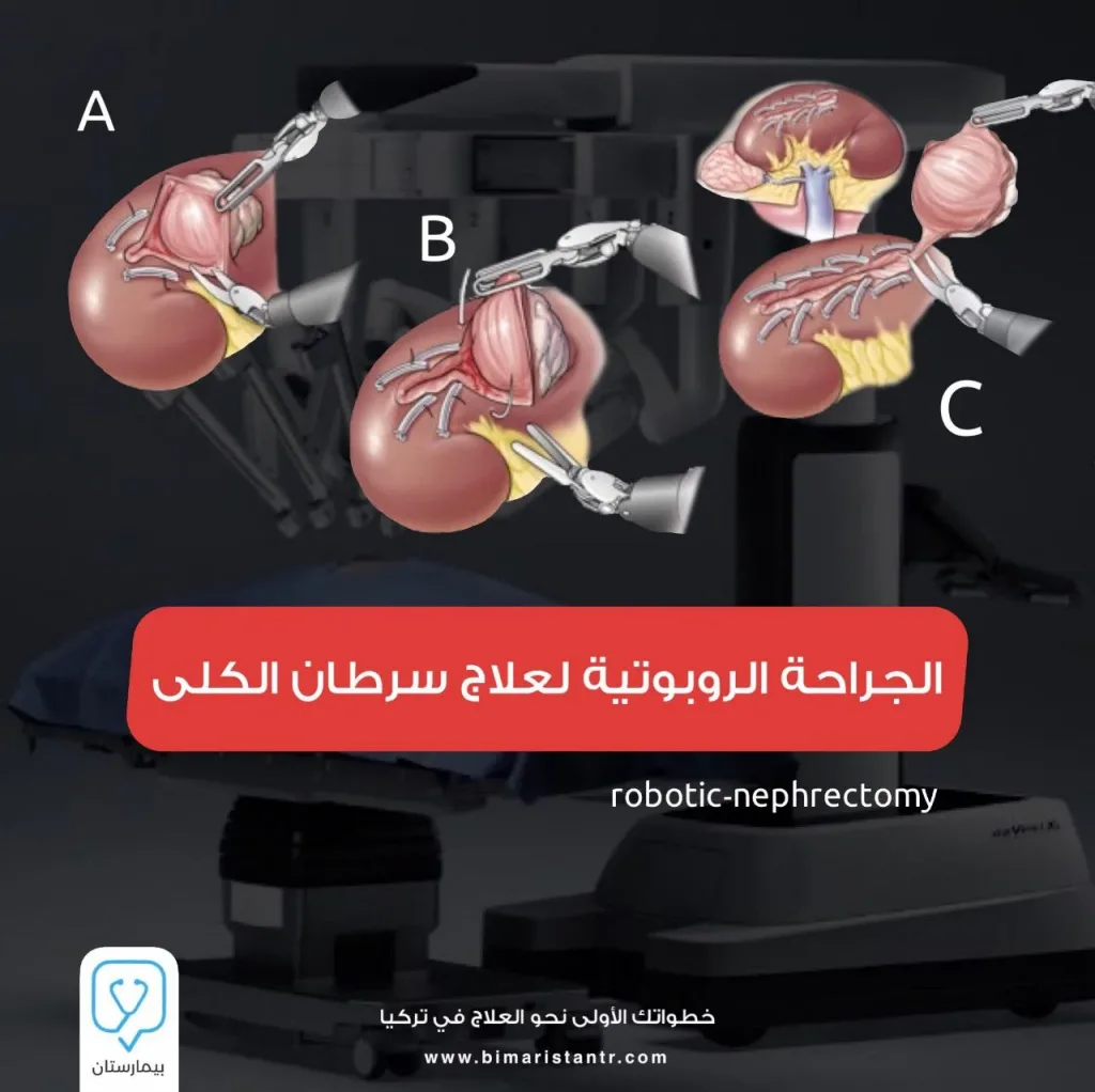 Robotic-surgery to treat kidney-cancer