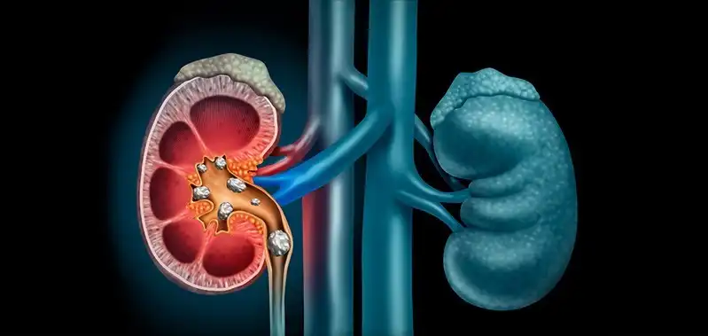 Stones inside the kidney