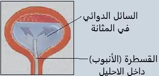 Catheters inside the urethra, which allow drugs to be inserted directly into the bladder