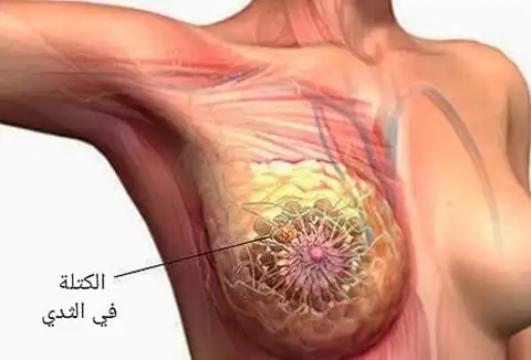 The arrow indicates a lump in the breast that may be malignant
