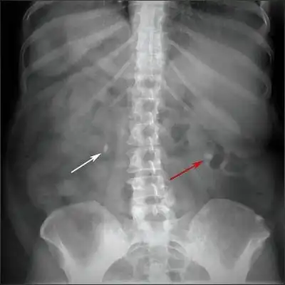 Diagnosis of kidney stones on a simple abdominal x-ray