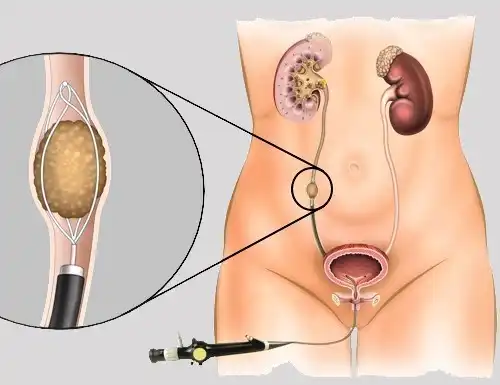 Ureteroscopy is a minimally invasive procedure where a small camera is inserted into the ureter and then techniques to break up stones such as lasers and others can be used