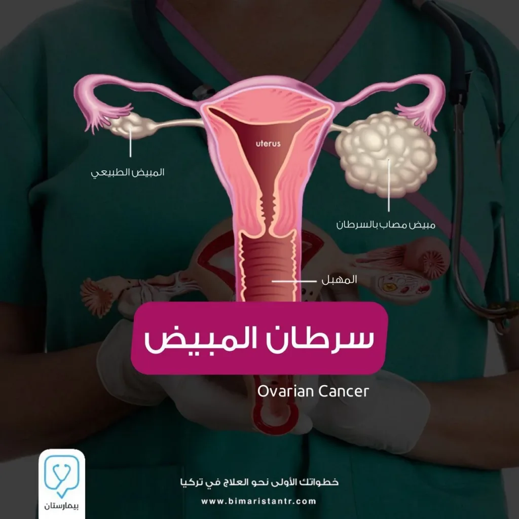Ovarian cancer - symptoms and treatment methods in Turkey