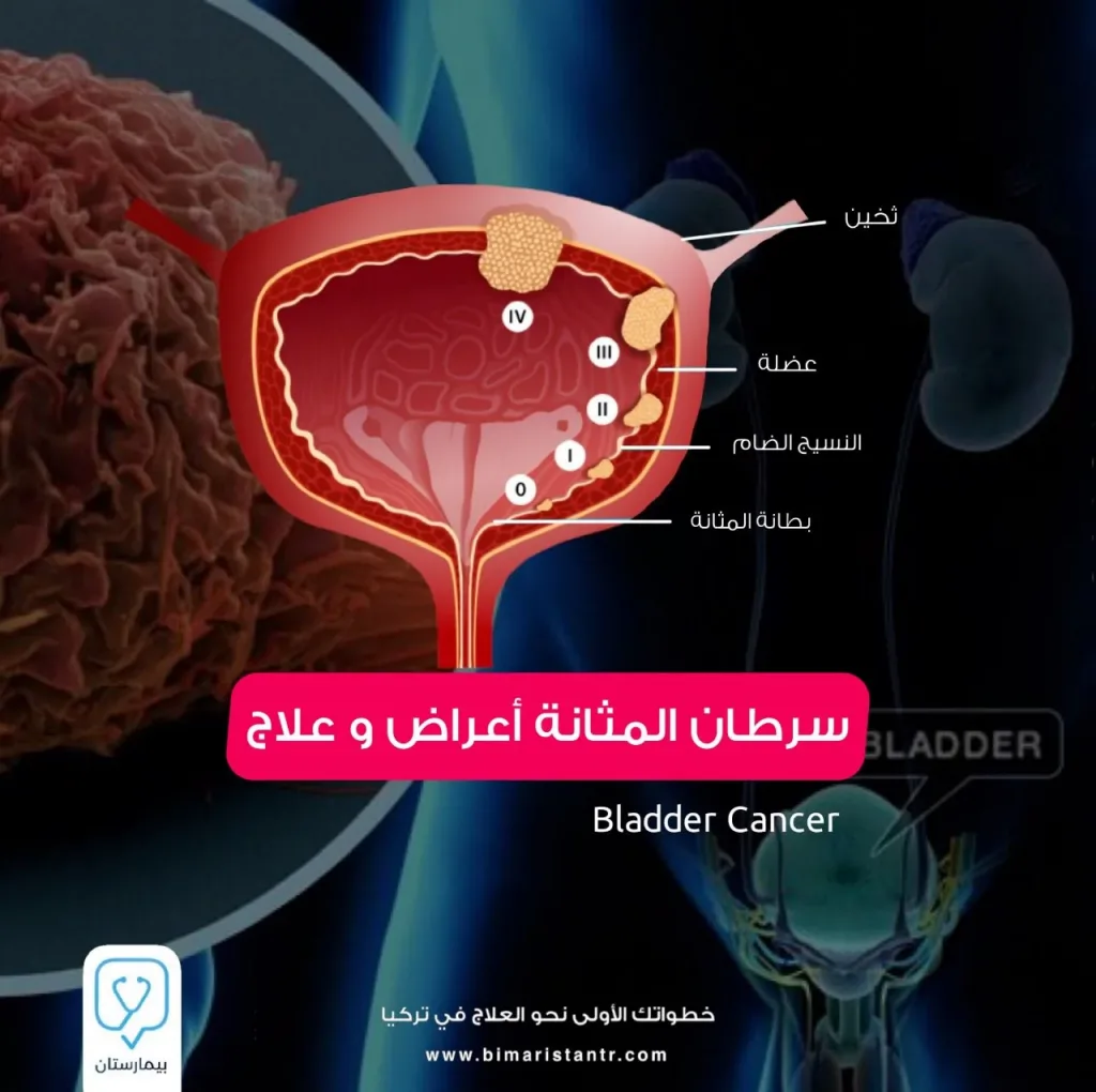 What you need to know about bladder cancer