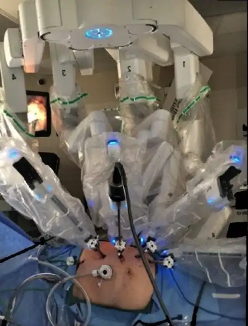 صورة تبين تموضع الأجهزة أثناء الجراحة الروبوتية لعلاج سرطان الكلى في تركيا