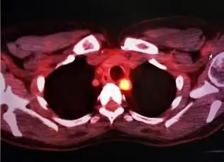 CT scan of a thyroid gland with cancer