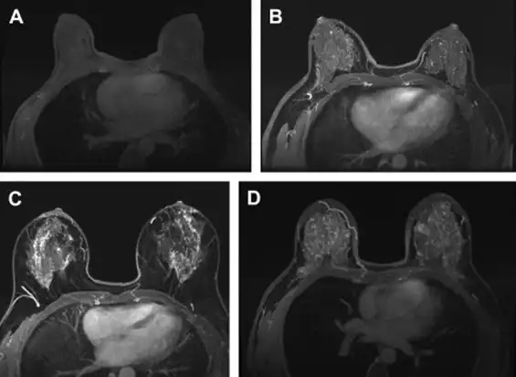 صور بالرنين المغناطيسي لسرطان الثدي