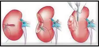 Stages of robotic partial nephrectomy