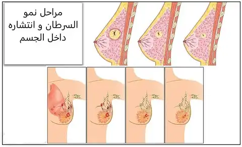 Stages of breast cancer growth and spread in the body