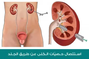 استئصال حصى الكلى عن طريق الجلد