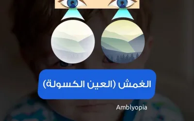 Amblyopia_lazy eye_causes and treatment in children and adults in Turkey