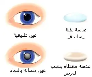 الفرق بين عدسة العين المصابة وغير المصابة