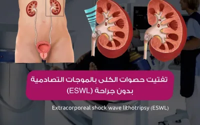 Non-surgical shock wave lithotripsy (ESWL)