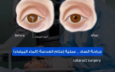 جراحة الساد cataract surgery_ عملية إعتام العدسة (الماء البيضاء)