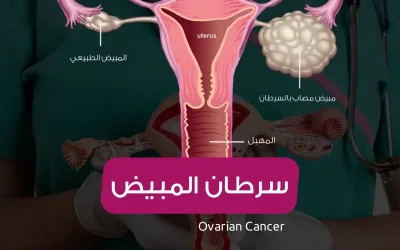 Ovarian cancer - symptoms - signs and treatment methods