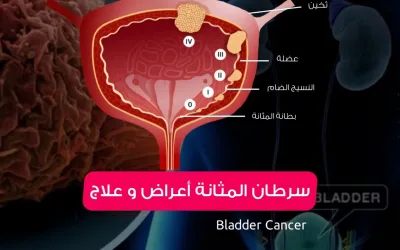 سرطان المثانة Bladder Cancer – أعراض و علاج